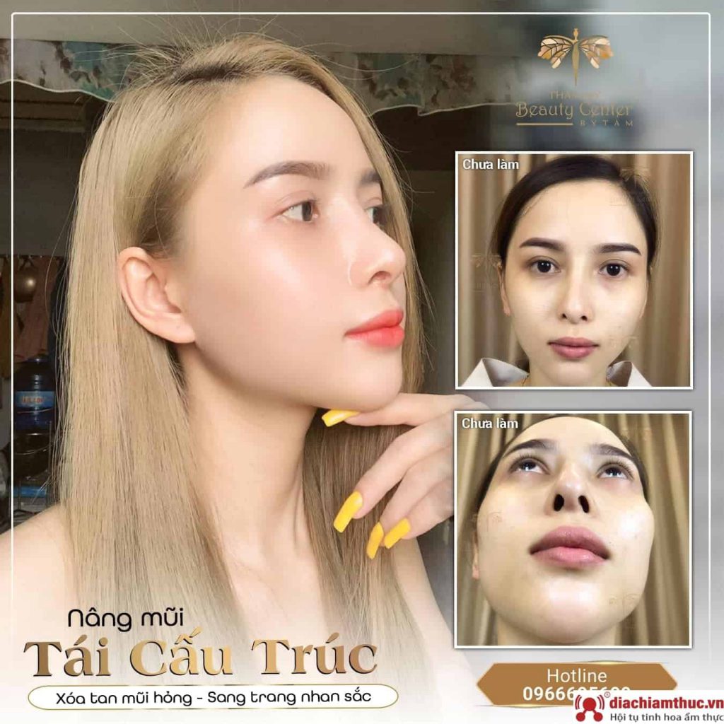 Thẩm mỹ Beauty Center – by Tấm - Nâng mũi